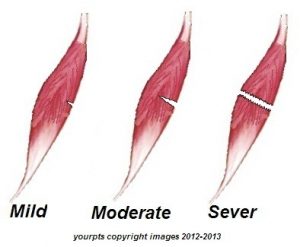 acute muscle injuries