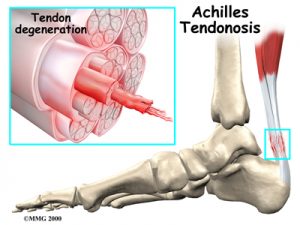 achilles pain