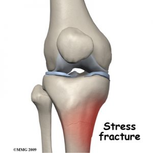 stress fractures