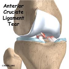 acl injury