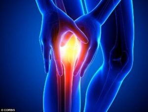 Arthritis of the knee