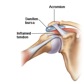 Subacromial Bursa